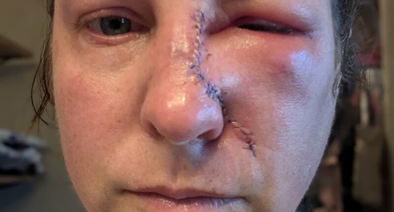 Mother-of-four, 43, reveals subtle mark she thought was just dry skin - but it was skin cancer: 'I ALWAYS wore sunscreen'