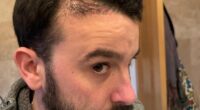 My £2,500 hair transplant left me looking a total fool. All men considering one need to read this and think again - even procedures at UK clinics end in disaster