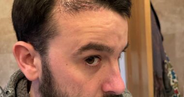 My £2,500 hair transplant left me looking a total fool. All men considering one need to read this and think again - even procedures at UK clinics end in disaster