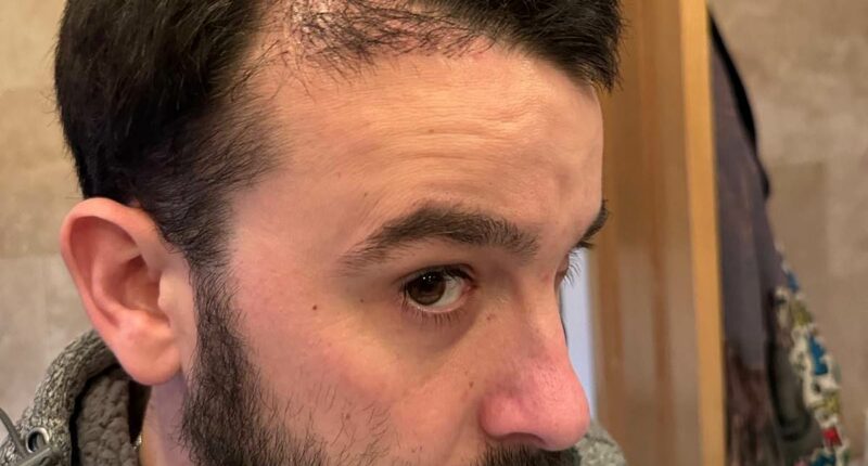 My £2,500 hair transplant left me looking a total fool. All men considering one need to read this and think again - even procedures at UK clinics end in disaster