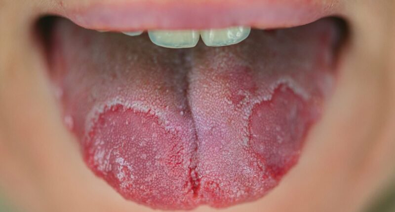 What to do about a crusty white tongue: DR ELLIE reveals what it means about your health, how to get rid of it... and when you should be concerned about cancer
