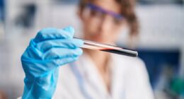 Breakthrough test could spot deadly motor neurone disease years before symptoms appear