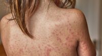 Child dies from measles complication years AFTER recovering from virus