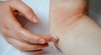 Concern as skin condition that hits millions is linked to raised risk of suicide