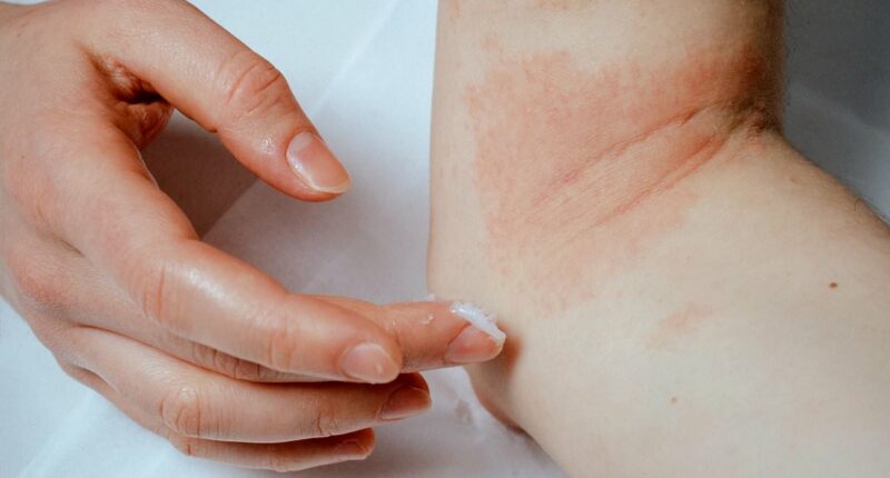 Concern as skin condition that hits millions is linked to raised risk of suicide