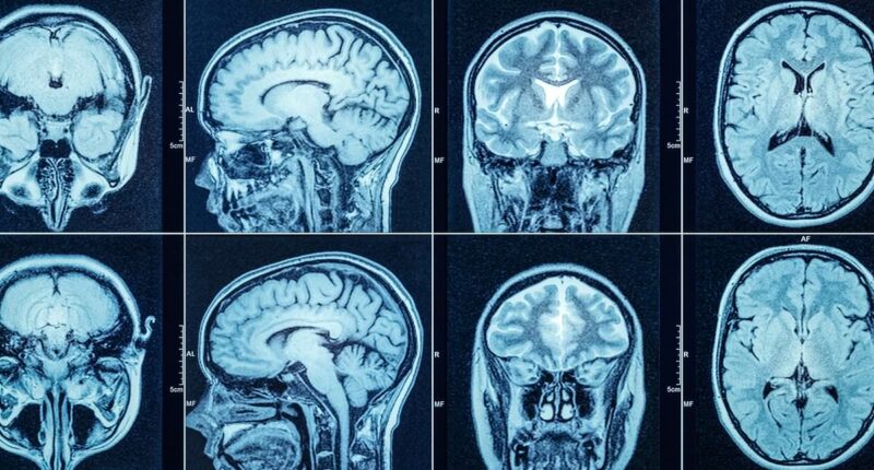Groundbreaking trial treats 'incurable' Huntington's disease for first time: Major breakthrough could slow development of disease which robs sufferers of speech and movement
