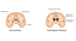 Huntington's disease successfully treated in 1st major breakthrough