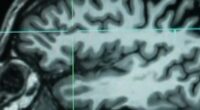 Huntington's disease treated for first time