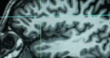 Huntington's disease treated for first time
