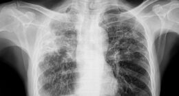 Panic spreads as Maine residents are infected with world's deadliest disease