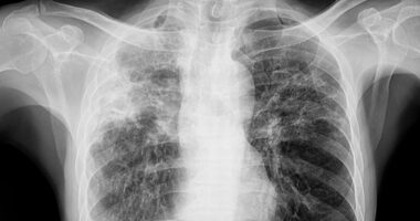 Panic spreads as Maine residents are infected with world's deadliest disease
