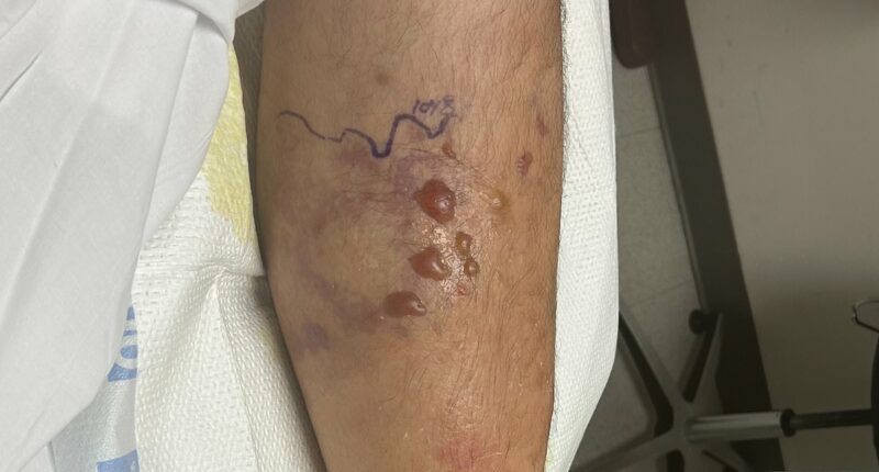 Rare flesh eating-bacteria claims another victim as officials urges public to take precautions