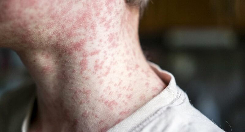 Thousands of people exposed to measles at major sporting event as infections spread
