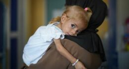 Toddler evacuated from Gaza with rare disease recovers from malnutrition in Italian hospital