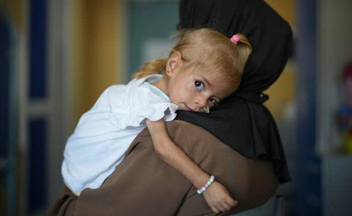 Toddler evacuated from Gaza with rare disease recovers from malnutrition in Italian hospital
