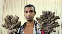 Tree Man Syndrome: Incurable condition leaves sufferers in agony as crusty brown skin spreads and covers their body in bark-like growths