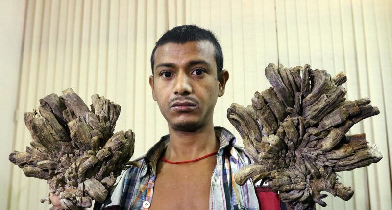 Tree Man Syndrome: Incurable condition leaves sufferers in agony as crusty brown skin spreads and covers their body in bark-like growths