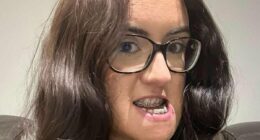 Woman, 26, reveals astonishing transformation after brutal five hour surgery to correct huge underbite: 'Pain was worth it'