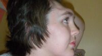 Grainne Kealy was left without a forehead for two years (pictured) after a freak car crash in 2006