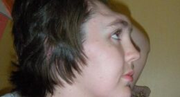 Grainne Kealy was left without a forehead for two years (pictured) after a freak car crash in 2006