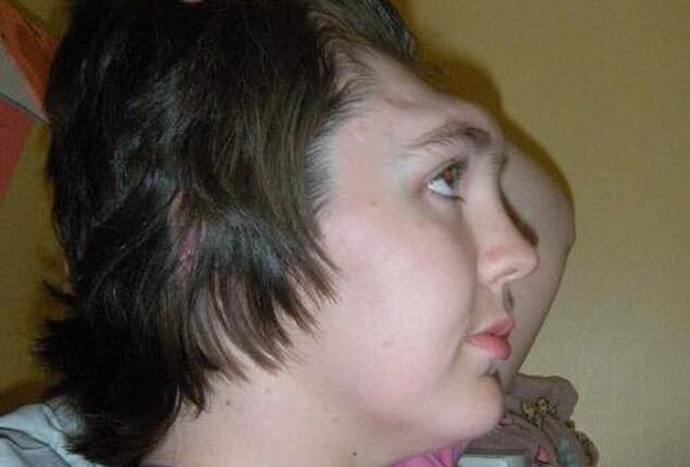 Grainne Kealy was left without a forehead for two years (pictured) after a freak car crash in 2006