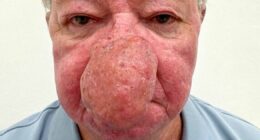 'I couldn't kiss my wife because my nose just kept growing'