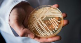 7 risk factors of deadly fungus infections identified, new Candida auris research finds