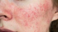 Have YOU got 'autumn face'? Why your skin flares up when the weather turns cold - and how to fix it, according to a top dermatologist