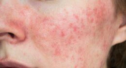 Have YOU got 'autumn face'? Why your skin flares up when the weather turns cold - and how to fix it, according to a top dermatologist