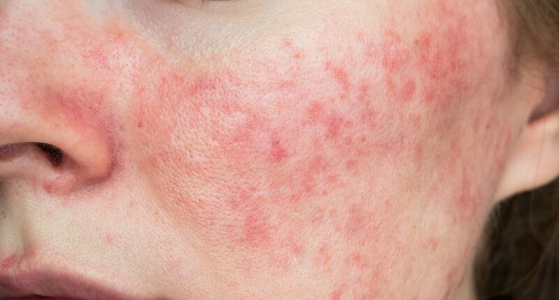 Have YOU got 'autumn face'? Why your skin flares up when the weather turns cold - and how to fix it, according to a top dermatologist