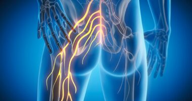 How to cure your sciatica for good - WITHOUT powerful drugs: Our experts reveal the simple steps and lifestyle tweaks to save yourself from the debilitating condition