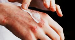 How to soothe dry, sore hands - skin specialists share the simple tricks that really work