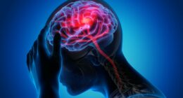 Huge breakthrough for stroke victims as doctors trial 'game-changing' pill that 'regrows' the brain