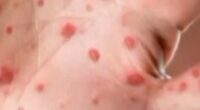 Hundreds of students quarantine amid measles outbreaks