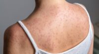 Most infectious disease surging across US at highest rate in 30 years