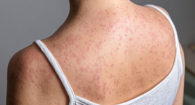 Most infectious disease surging across US at highest rate in 30 years
