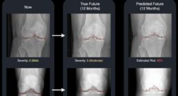Osteoarthritis breakthrough as incredible new tech can predict patients' future X-rays