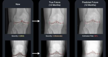 Osteoarthritis breakthrough as incredible new tech can predict patients' future X-rays