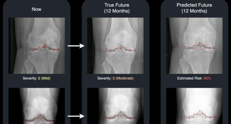 Osteoarthritis breakthrough as incredible new tech can predict patients' future X-rays