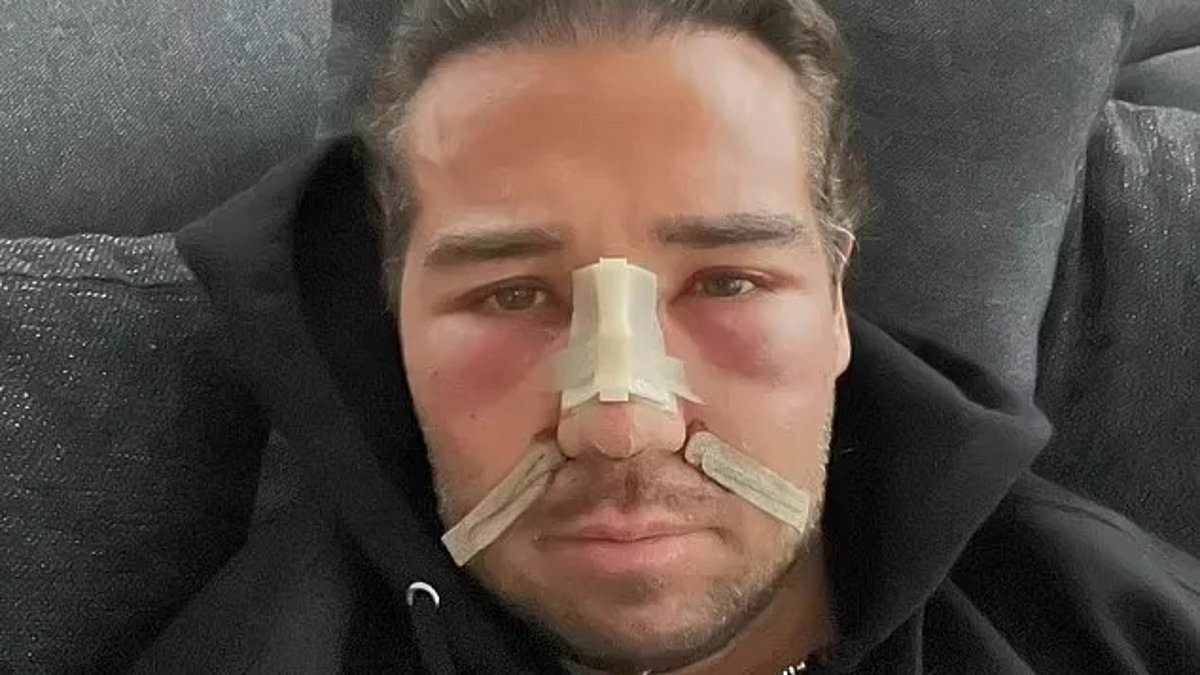 TOWIE Star James Lock Invests £100K in Cosmetic Transformation at 38