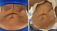 Weight loss jabs spike sees soaring number of Brits seek saggy skin treatment