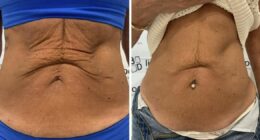Weight loss jabs spike sees soaring number of Brits seek saggy skin treatment