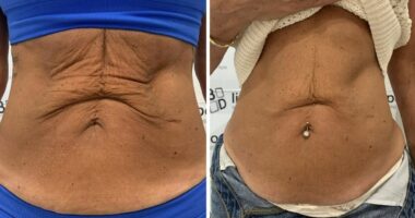 Weight loss jabs spike sees soaring number of Brits seek saggy skin treatment