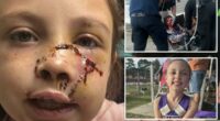 Alabama girl, 9, mauled by dog that 'grabbed' her face, leaving brutal injuries