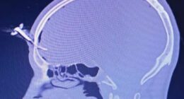 Car key ends up embedded in footballer's forehead after fight