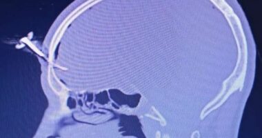 Car key ends up embedded in footballer's forehead after fight