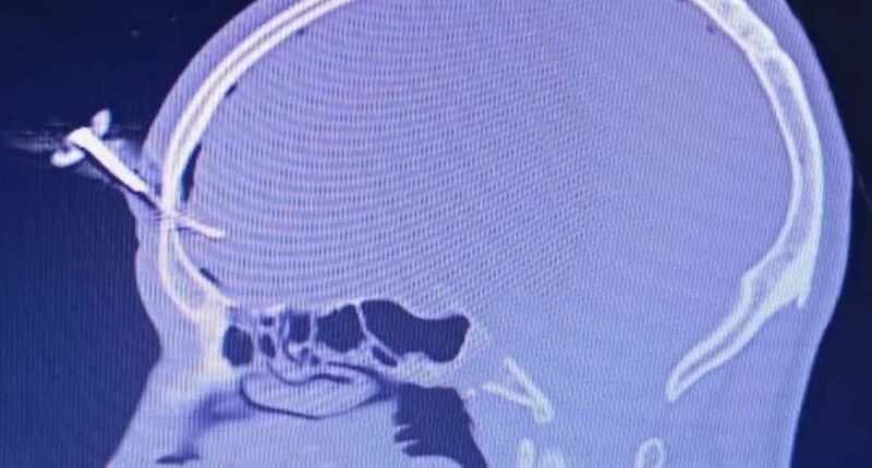 Car key ends up embedded in footballer's forehead after fight