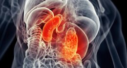 Chronic kidney disease has more than DOUBLED since 1990 to 800 million, experts discover: 'It's a growing global health crisis'