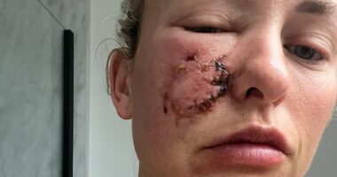Dog owner who suffered attack on her face has pioneering treatment