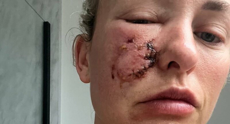 Dog owner who suffered attack on her face has pioneering treatment